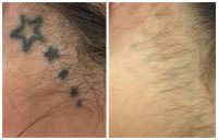 Rimozione tatuaggi col laser: prima e dopo