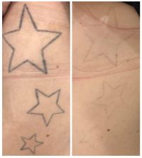 Rimozione tatuaggi col laser: stelline, prima e dopo