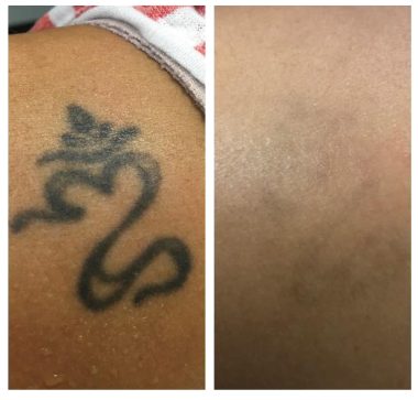 Rimozione tatuaggi col laser: simbolo scuro, prima e dopo